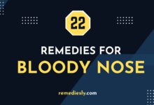 Remedies for Bloody Nose
