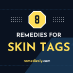 8 Effective Remedies for Skin Tags