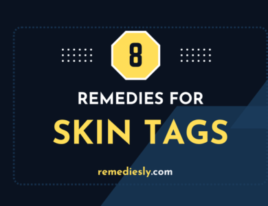 8 Effective Remedies for Skin Tags
