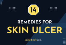 natural remedies for skin ulcer